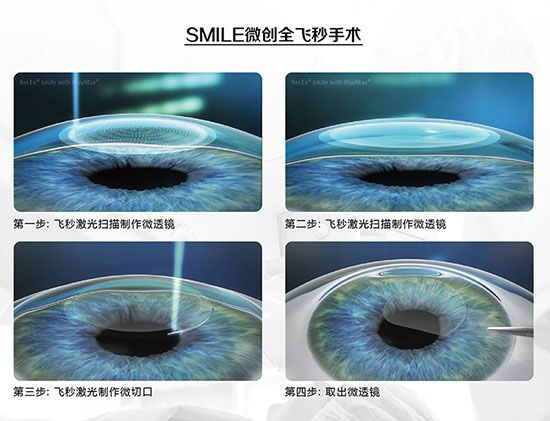 蔡司全飛秒、蔡司半飛秒近視手術(shù)與蔡司全飛秒flex手術(shù)