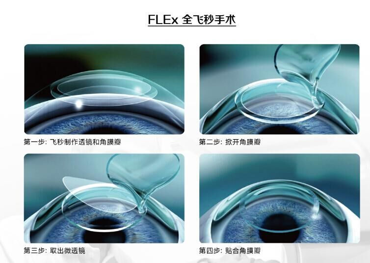 蔡司全飛秒、蔡司半飛秒近視手術(shù)與蔡司全飛秒flex手術(shù)