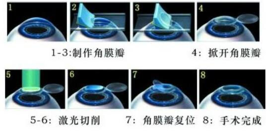 準(zhǔn)分子激光手術(shù)到底是怎么治 愈你的眼睛的？