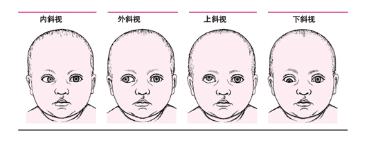 兒童視力保衛(wèi)戰(zhàn)：小孩斜視怎么判斷?