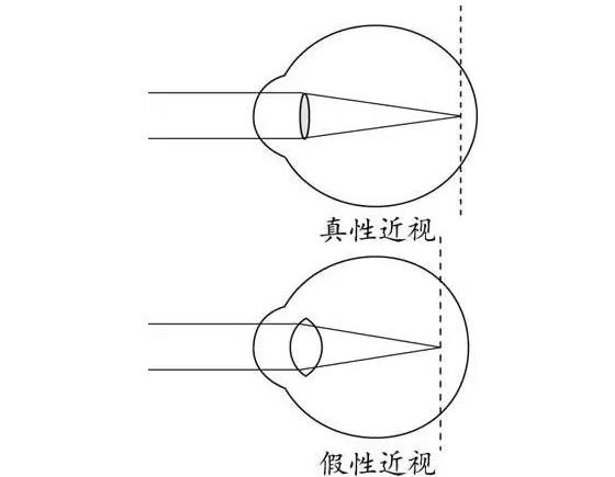 關(guān)于青少年近視的三個“小姿勢”